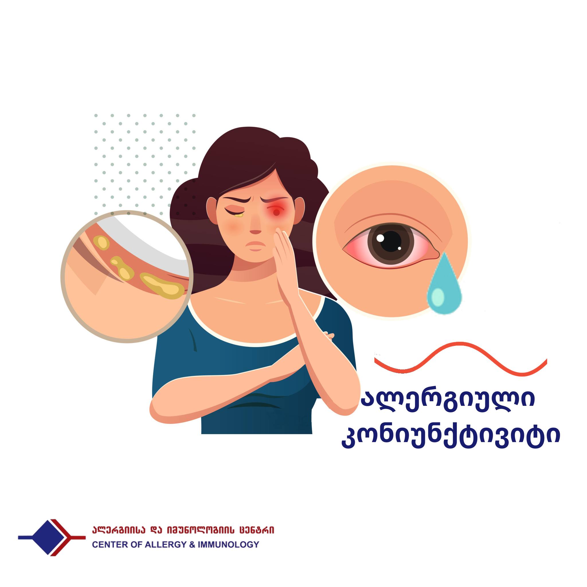 ალერგიული კონიუნქტივიტი