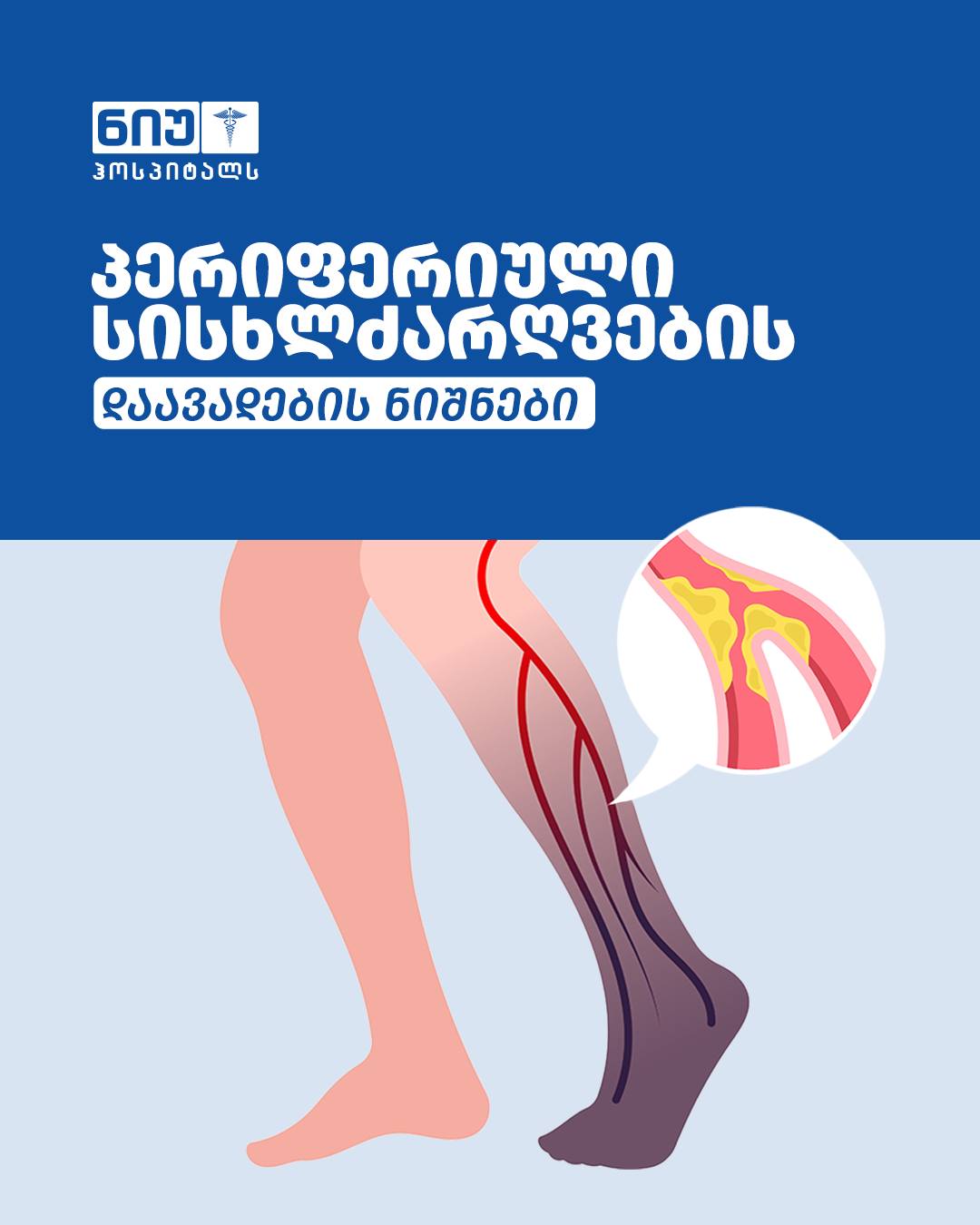 პერიფერიული სისხლძარღვების დაავადების ნიშნები