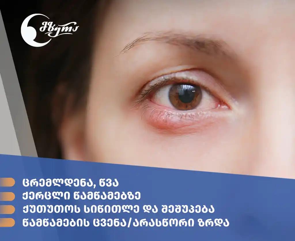 რა არის ბლეფარიტისათვის დამახასიათებელი სიმპტომები?