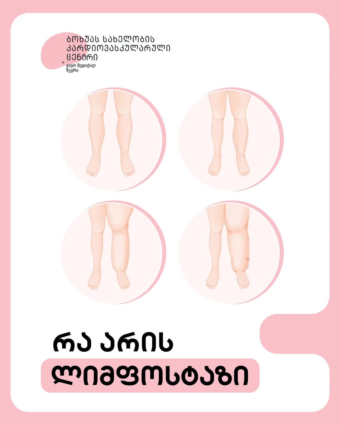 რა არის ლიმფოსტაზი, რატომ ვითარდება და როგორ ვმართოთ