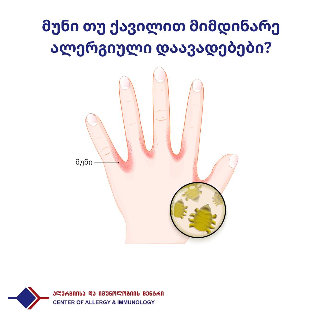 მუნი და ქავილით მიმდინარე ალერგიული დაავადებები